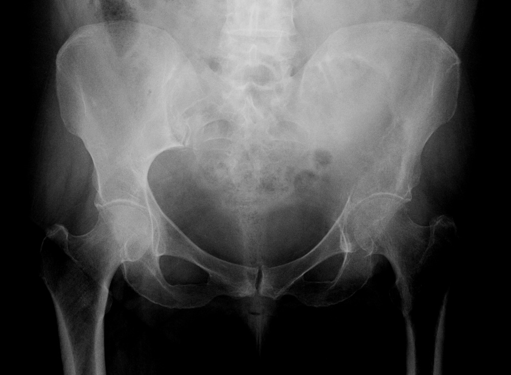 Bone Tumours And Benign Lytic Lesions